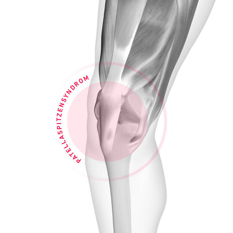Schematic representation of patella tip syndrome