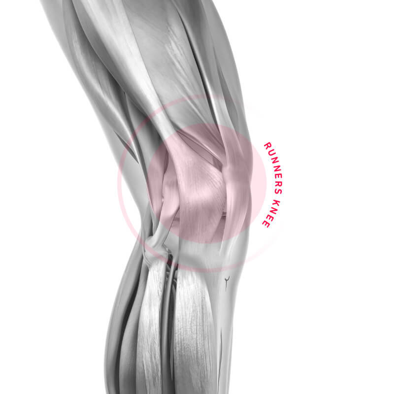 Schematic representation of the aching area with a knee