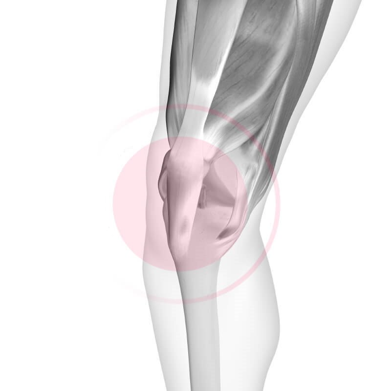 Patellaspitzensyndrom.jpg Patellaspitzensyndrom.jpg