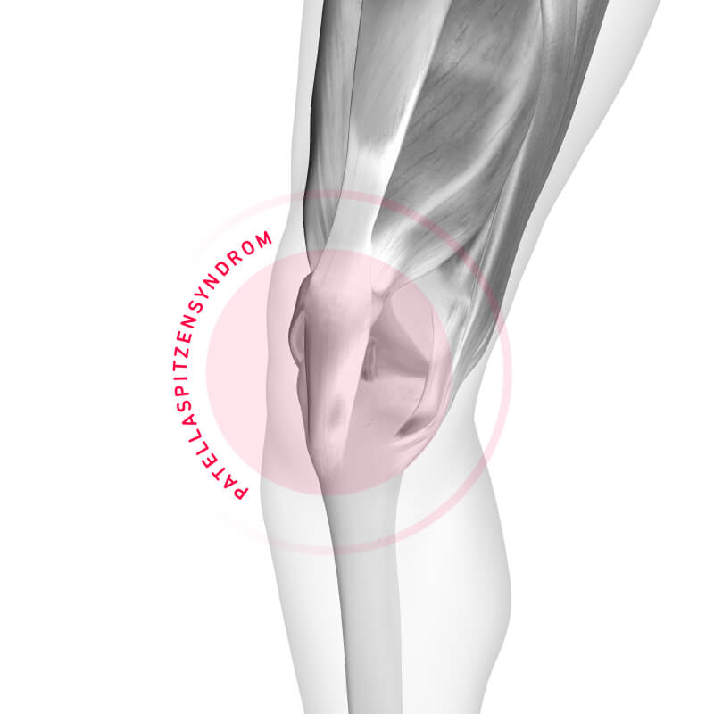 Schematische Darstellung Knieschmerzen beim Laufen Mit Patellaspitzensyndrom